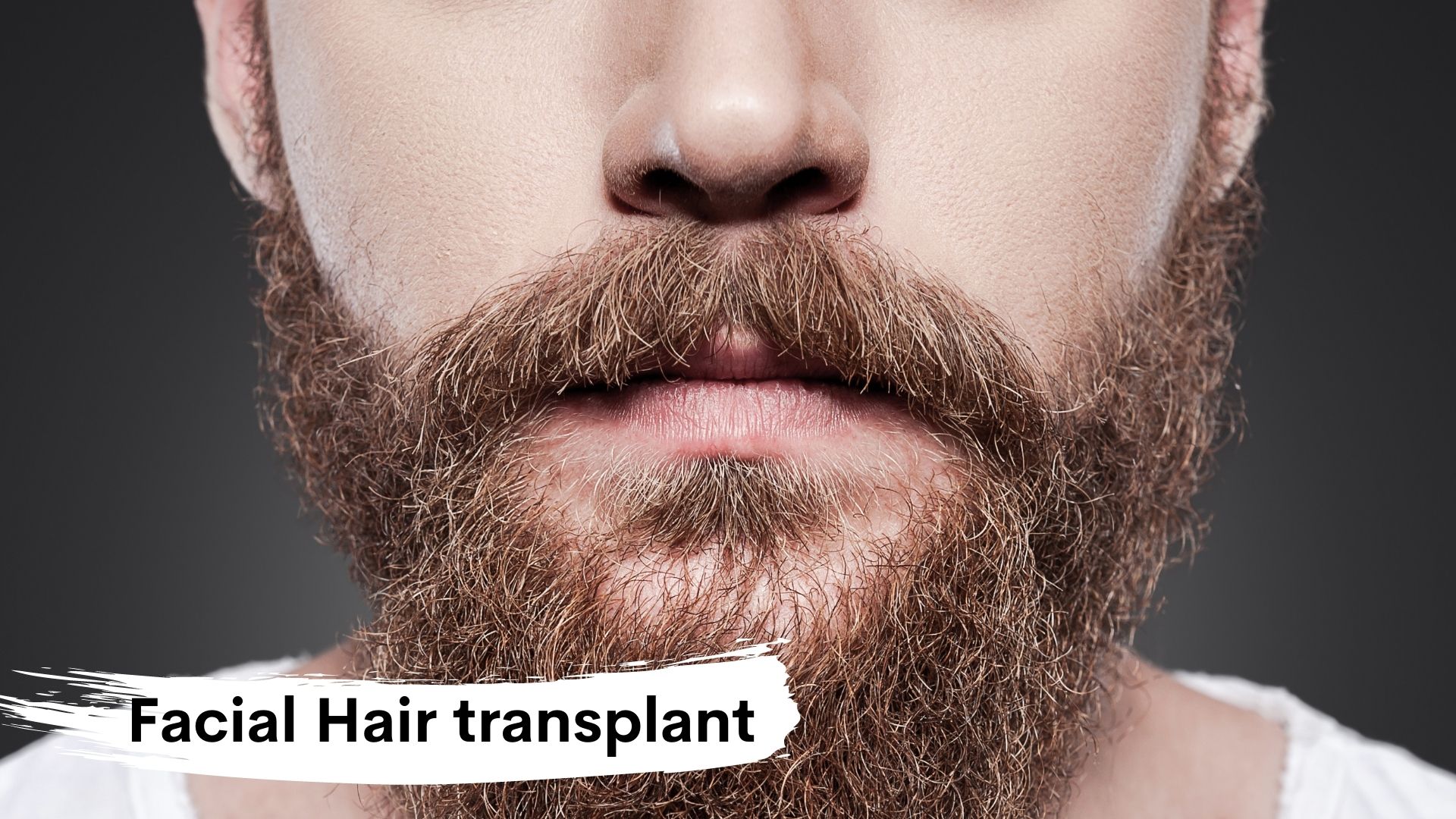 facial hair transplant